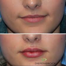 lip fillers injections gallery