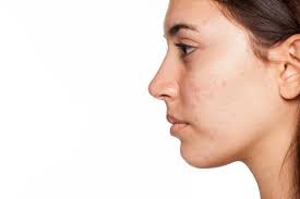 tips and tricks to reduce acne