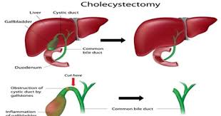 cholecystectomy gallbladder removal