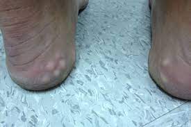 derm dx white lumps on the heel when