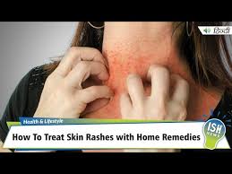 treat skin rashes with home remes