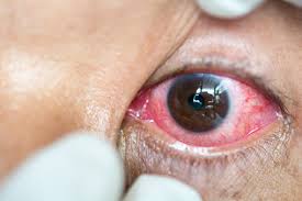 shingles in the eye herpes zoster