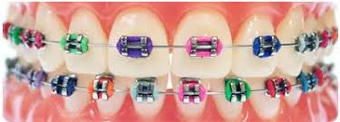 What The Color Of The Rubber Bands On Your Braces Mean