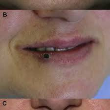 lip hemangioma using forced dehydration