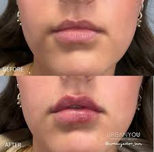 how to get a lip flip with botox