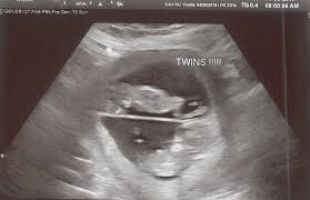 Twin pregnancy symptoms and conditions. 11 Weeks Pregnant With Twins Tips Advice How To Prep Twiniversity