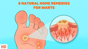 8 surprising home remes for warts