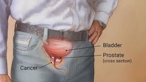 prostate cancer advanced urology