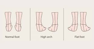 Learn Your Foot Arch Type With The Wet Test Heel That Pain