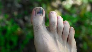 bruised toenails from hiking try these