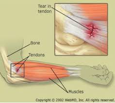 Forearm tendinitis is a painful condition caused by inflammation of a tendon, i.e., a sinew that connects muscle to bone.this is often the result of overuse, although it can also be caused by an acute injury. Elbow Forearm Tendon Ligament Tear Health Life Media