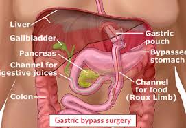 gastric byp surgery gastric byp