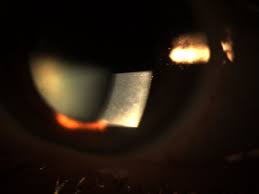 Corneal dystrophy, epithelial basement membrane »symptoms of corneal these medical condition or symptom topics may be relevant to medical information for corneal dystrophy, anterior basement membrane Planning Ahead For Corneal Epithelial Dystrophy A Teaching Case Report The Journal Of Optometric Education