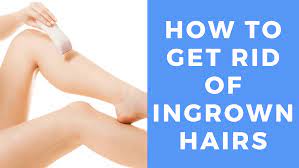 how to get rid of ingrown hairs full