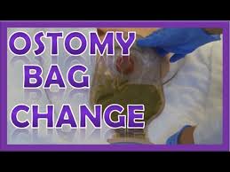 Ostomy Bag Pouch Change Ostomy Care Nursing Colostomy Ileostomy Bag Change