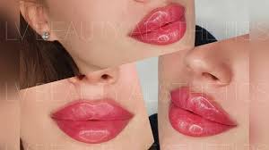 best clinics for lip fillers near me in
