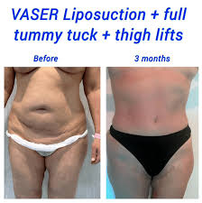 weight after vaser liposuction