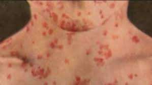 Image result for measles