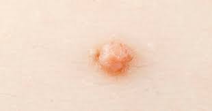 are warts always caused by hpv