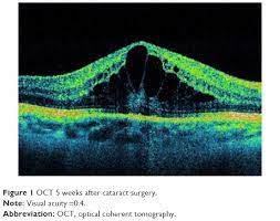 pseudophakic cystoid macular edema