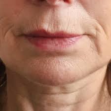 vertical lip lines or wrinkles case