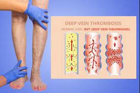 Some of these symptoms are â€¦ blood clots in the stomach, or an abdominal blood clot, are a type of deep vein thrombosis (dvt). Is Your Leg Pain Normal Or Is It A Blood Clot Bone Joint