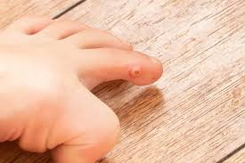 the cause of warts on your feet