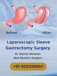 laparoscopic sleeve gastrectomy surgery