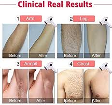 Offering single area & full body laser hair removal services in indianapolis, in. Amazon Com Laser Hair Removal For Women Men Imene 500 000 Flashes Ipl Permanent Hair Removal Upgrade Ice Compress Home Use Hair Remover On Bikini Line Legs Arms Armpits More