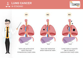 Lung Cancer Tnm Staging Explained With Infographics In Easy Way
