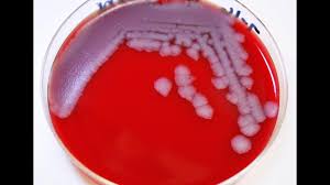 Image result for anthrax