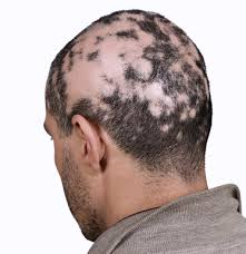 Discover patient management tips and treatment of alopecia advice. Hilfe Zu Alopecia Areata Krankheitsbild Kreisrunder Haarausfall Falle Aus Der Praxis