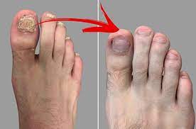 fungal toenails feet for life