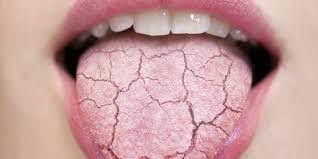 8 home remes for dry mouth