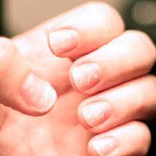 brittle nails causes risk factors