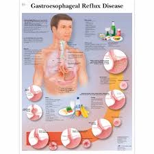 Gastroesophageal Reflux Disease Chart Gerd