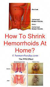 The thrombosed hemorrhoid may heal with scarring, and leave a tag of skin protruding in the anus. Battery Reconditioning Charger Batteryreconditioningstanleycharger Post 7890932223 Recoverybattery Bleeding Hemorrhoids Hemorrhoids Treatment Hemorrhoids