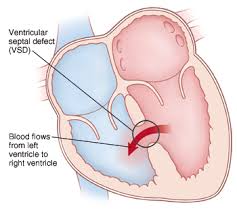 At times, hole in heart symptoms can be so trivial that its impact does not appear for many years or until adulthood, while at other times, it may require symptoms of vsd manifest soon after the birth of the baby, in the first few days, weeks or months itself. When Your Child Has A Ventricular Septal Defect Vsd Saint Luke S Health System
