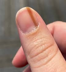 tan streak on woman s nail was skin cancer