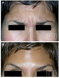 eyebrows and periorbital complex