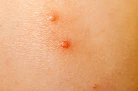 After they 'currete' a molluscum, there will be a tiny scrape (the same size as your molluscum). Molluscum Contagiosum Caring For Kids