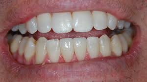 Cosmetic Dentists Of Franklin Porcelain Crowns