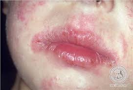Resultado de imagen para enfermedades de la piel dermatitis