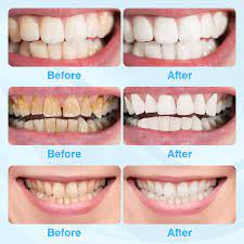 douceur teeth whitening kit teeth