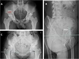 Learn vocabulary, terms and more with flashcards only rub 220.84/month. The Lateral Center Edge Angle As Radiographic Selection Criteria For Periacetabular Osteotomy For Developmental Dysplasia Of The Hip In Patients Aged Above 13 Years Bmc Musculoskeletal Disorders Full Text