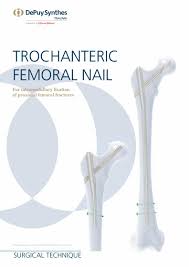 trochanteric fem nail surgical