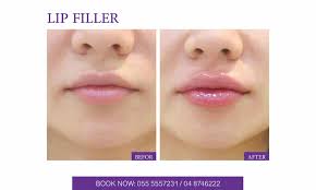lip fillers derma one cal center