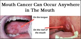 mouth cancer symptoms diagnosis and