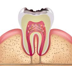 cavity pain causes treatment newmouth