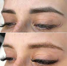 laser removal of eyebrow microblading